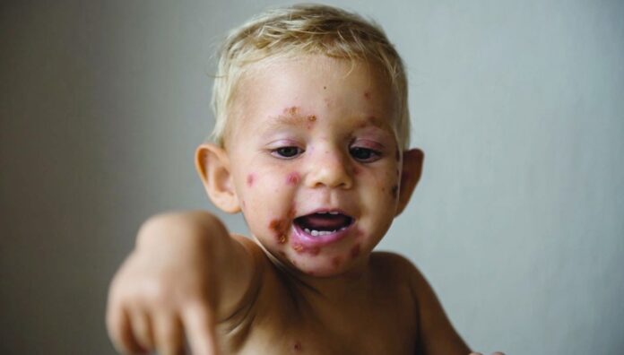 impetigo-face_2