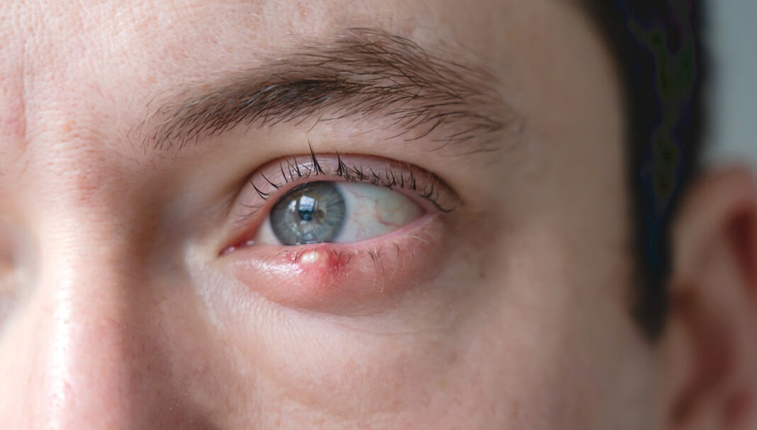 stye-GettyImages-2190656628