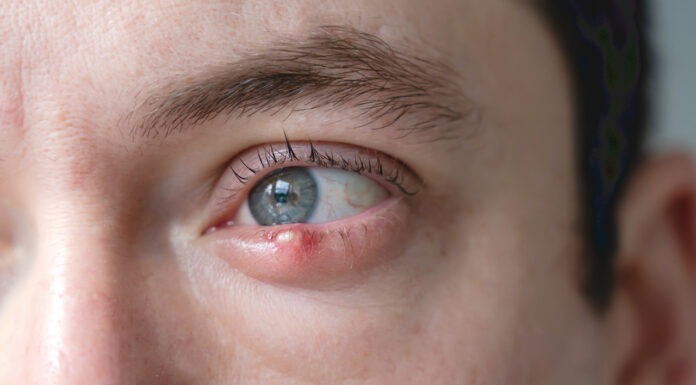 Stye no more: a practical guide for management