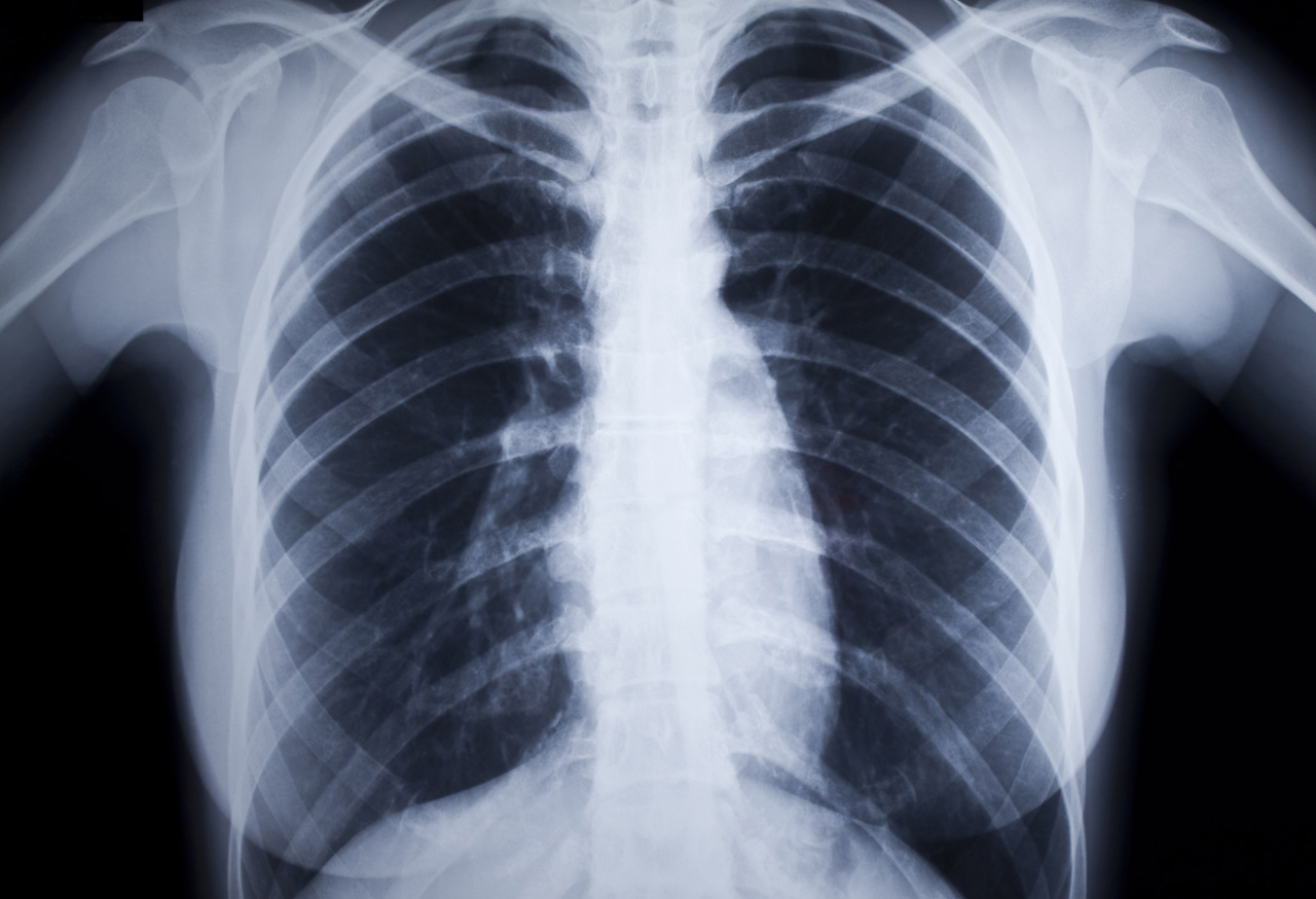 Once-daily triple therapy for COPD to be PBS listed x-ray of chest