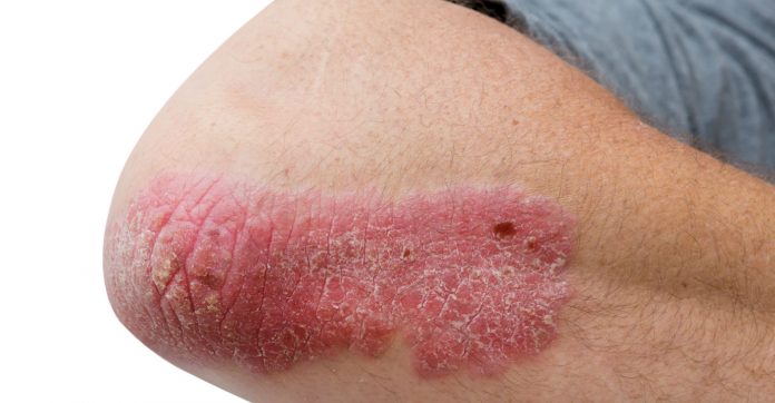 psoriasis PBS