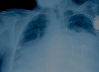 Systemic corticosteroids for dyspnoea corticosteroids