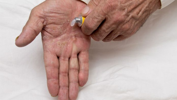 Eczema atopic dermatitis