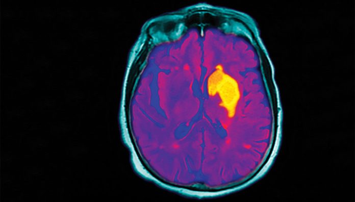 cpd-stroke-feature