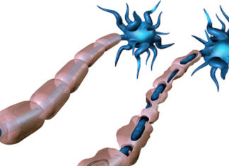 The efficacy of ocrelizumab for multiple sclerosis Illustration of nerve cell damage in multiple sclerosis, showing demyelination targeted by ocrelizumab treatment