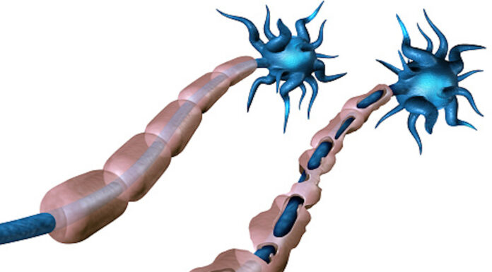 The efficacy of ocrelizumab for multiple sclerosis Illustration of nerve cell damage in multiple sclerosis, showing demyelination targeted by ocrelizumab treatment