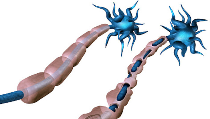 gettyimages-1086330468-170667a Illustration of nerve cell damage in multiple sclerosis, showing demyelination targeted by ocrelizumab treatment