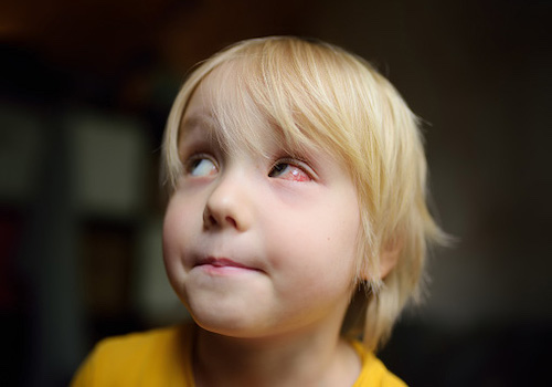 Young child with red, irritated eyes