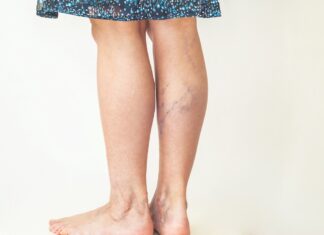 Efficacy of antiplatelets in deep venous thrombosis Visible leg veins may indicate deep venous thrombosis, highlighting the importance of antiplatelet efficacy