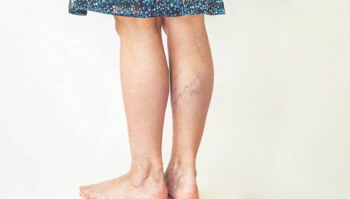 dreamstime_l_119807683 Visible leg veins may indicate deep venous thrombosis, highlighting the importance of antiplatelet efficacy