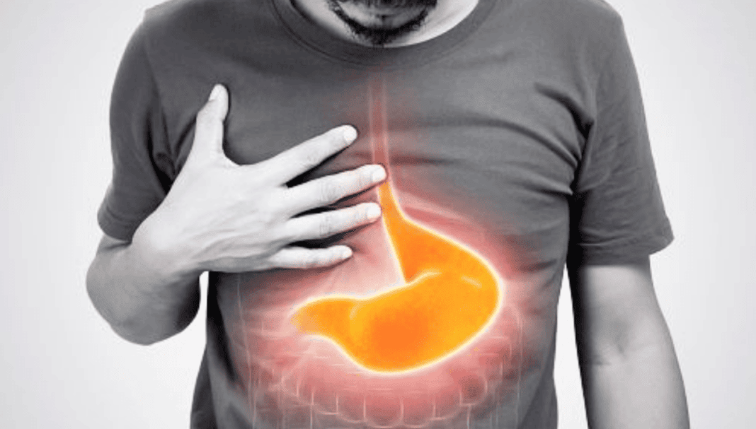 PPI_HI_getty_1478557919 Individual experiencing gastroesophageal reflux symptoms, highlighting the area affected by proton pump inhibitors (PPIs).