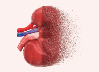 Finding the missing millions with CKD