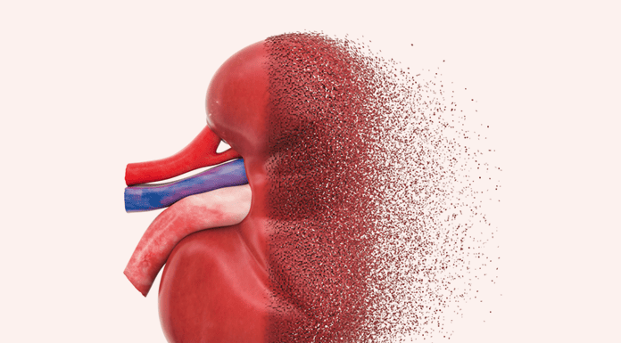 Finding the missing millions with CKD