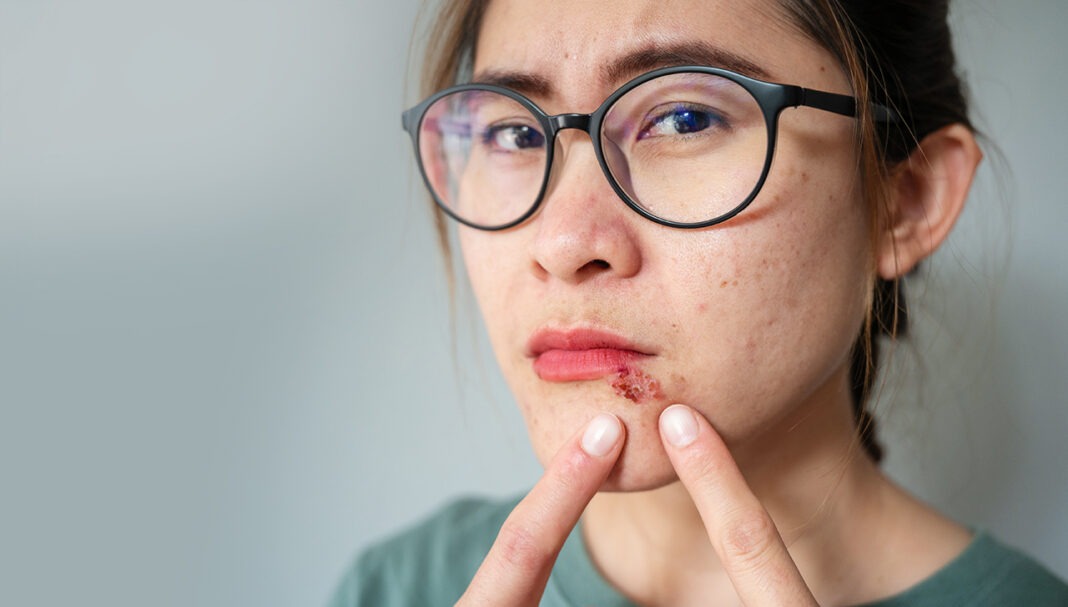 cold-sores-GettyImages-1310374467
