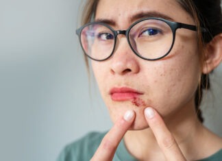 Stop the tingle: cold sore care essentials