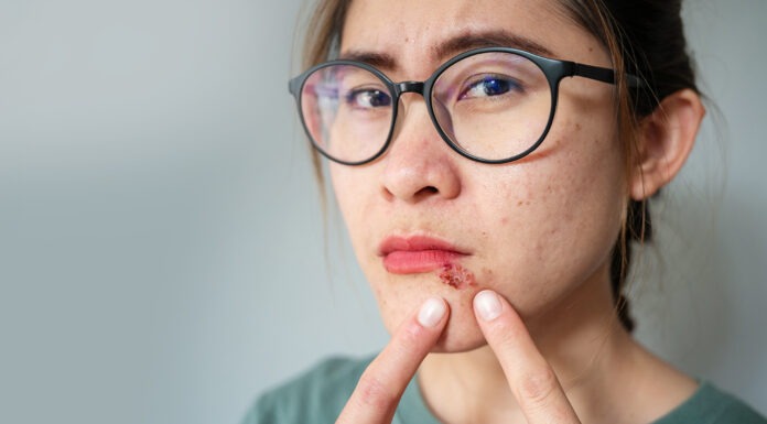Stop the tingle: cold sore care essentials