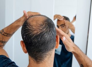 Managing pattern hair loss in pharmacy