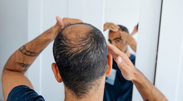 Managing pattern hair loss in pharmacy