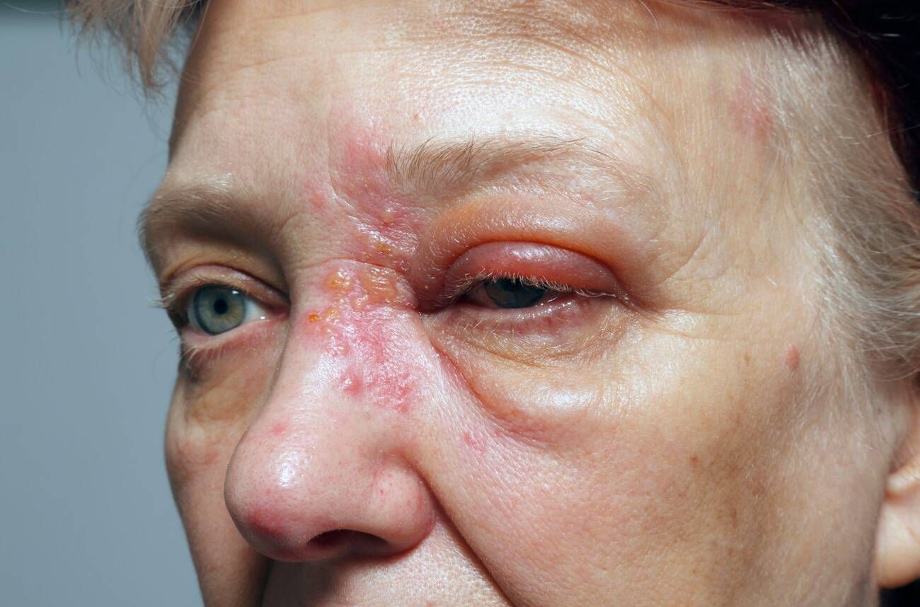 Close-up of a person's face with visible herpes zoster ophthalmicus rash and swelling around the eye