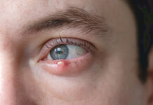 Stye no more: a practical guide for management