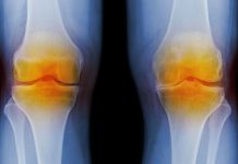 osteoarthritis