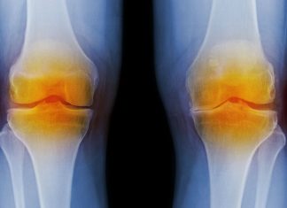 osteoarthritis