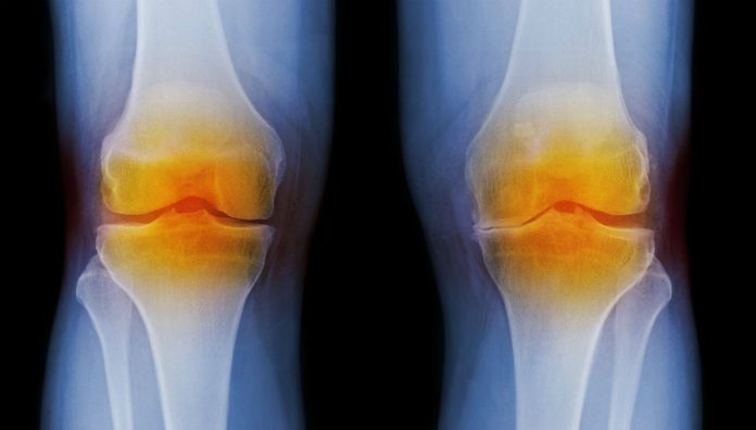 osteoarthritis