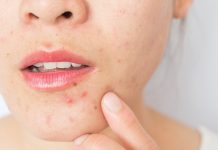 Topical management of acne acne