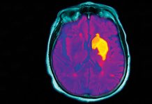 Stroke management in 2020