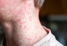 measles