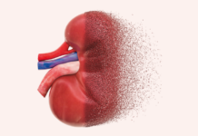 Finding the missing millions with CKD