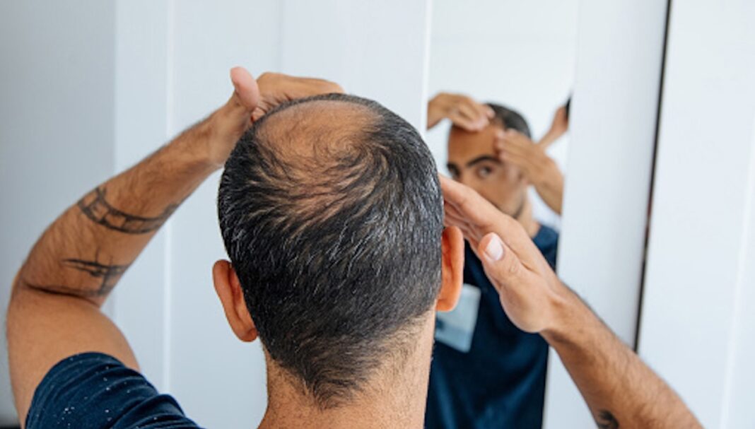 Bald man looking mirror at head baldness and hair loss